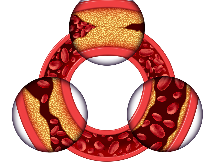 A Breakthrough Test for Coronary Artery Disease