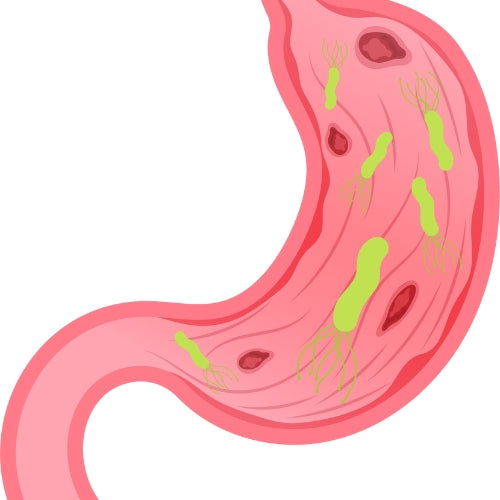 Bloating, Gas, Irritable Bowel SyndromeDo You Have SIBO?