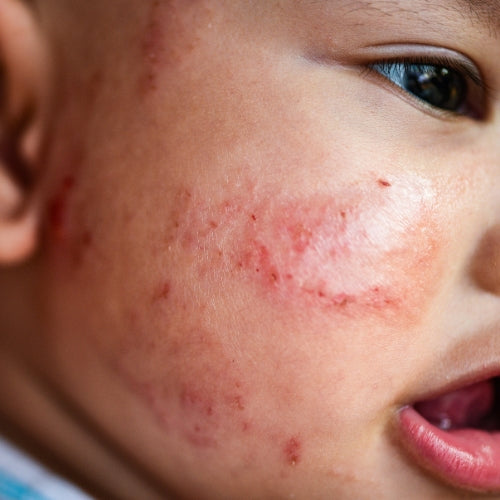 Eczema & Gut Connection