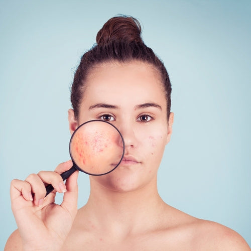 WHAT CAUSES ACNE?