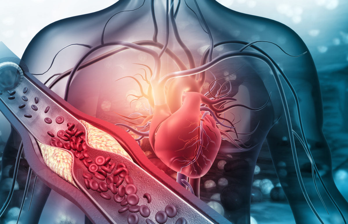 Are Your Arteries Plugged?