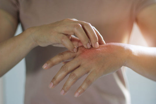 Eczema