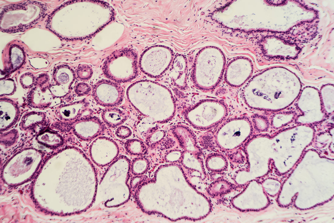 Help for Fibrocystic Breasts