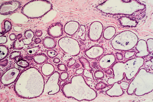 Help for Fibrocystic Breasts