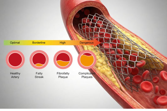 Coronary Artery Disease (CAD): What It Is, Why It Happens, and What You Can Do