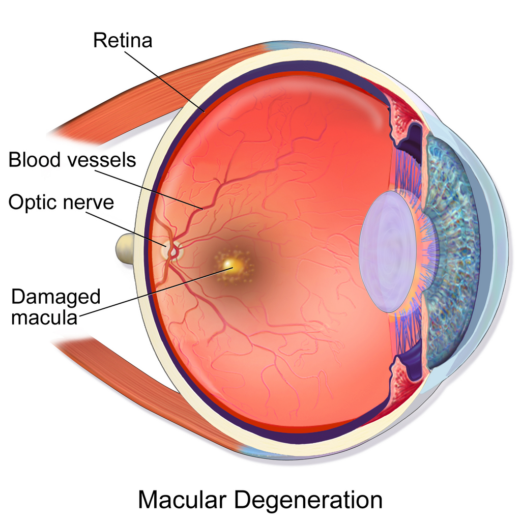 Picture of the back of the eye showing intermediate age-related macular degeneration